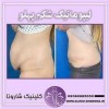 پروتز سینه و لیپوماتیک در تجریش