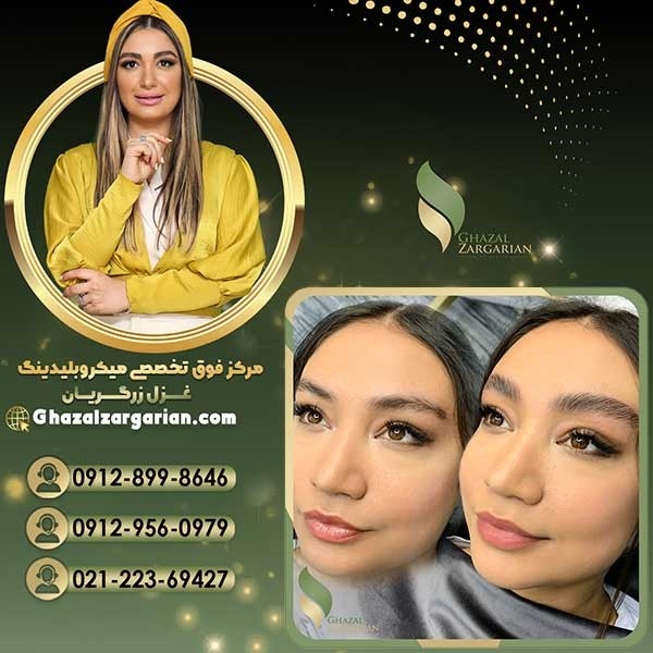 هزینه لیفت ابرو با مواد در بهترین مرکز