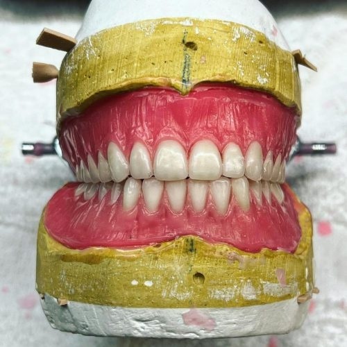 ساخت انواع دندان مصنوعی،ساخت پلاک کروم کبالت