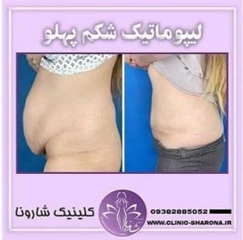 پروتز سینه و لیپوماتیک در تجریش
